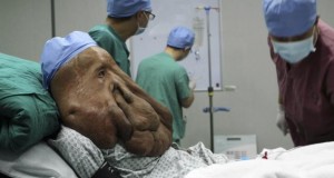‘Elephant Man’ gets Christmas surgery